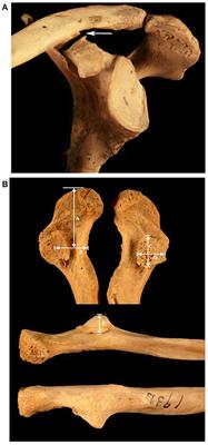 Prevalence and Morphology of the Coracoclavicular Joint: An Osteological Study of 2,724 Subjects Using Univariable and Multivariable Logistic Regression Analyses